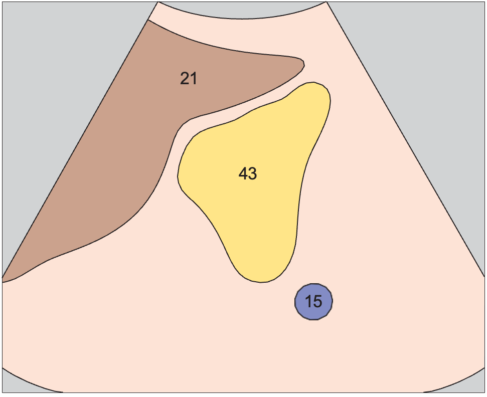 Left renal vein anatomy diagram, Tail of pancreas