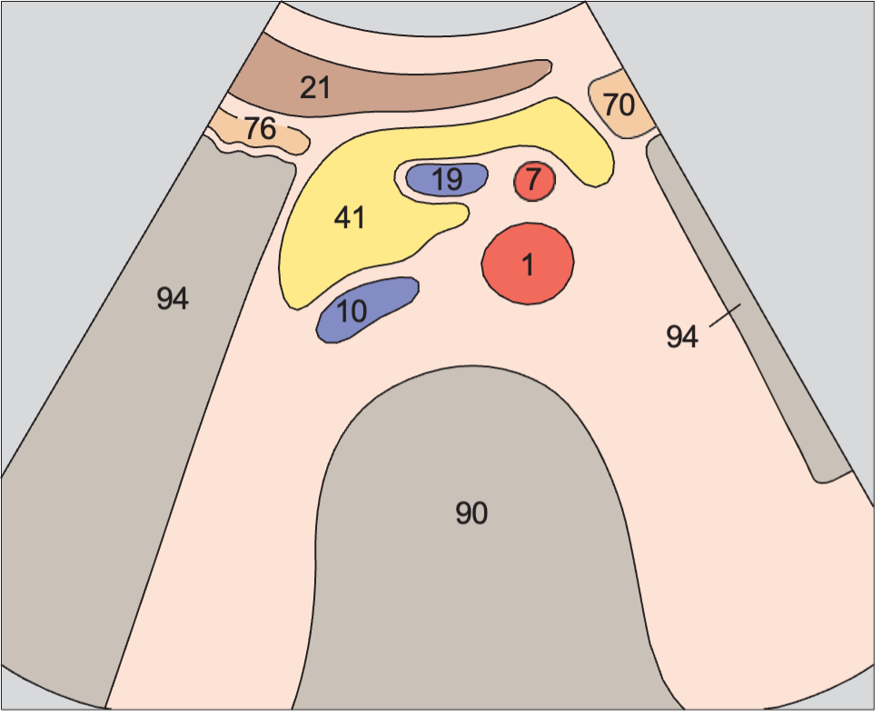 Duodenum anatomy diagram, Infrarenal aorta and vena cava