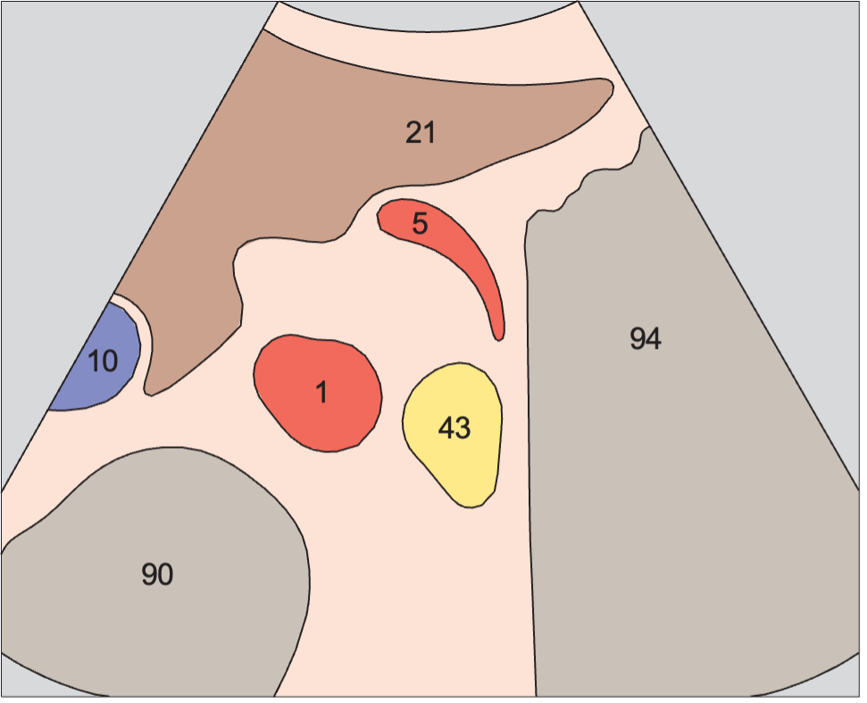 Artifact anatomy diagram, Tail of pancreas, splenic artery