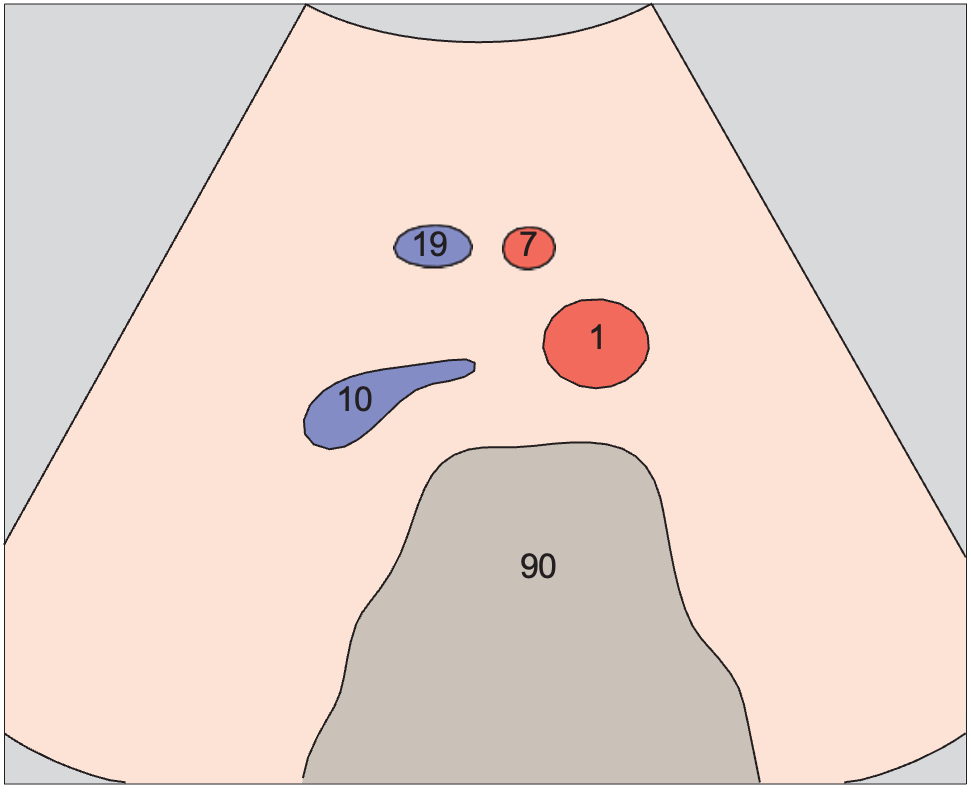 Superior mesenteric artery anatomy diagram, Infrarenal aorta, vena cava, superior mesenteric artery and vein