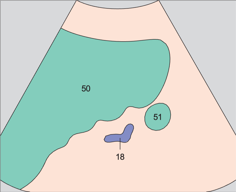 Spleen anatomy diagram, Accessory spleen
