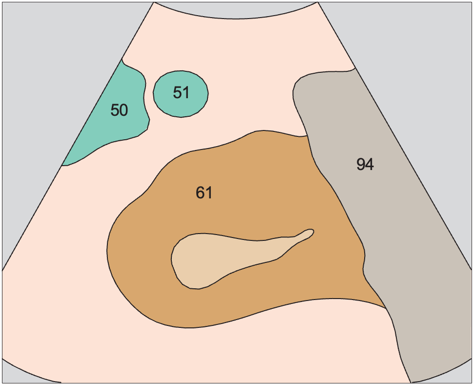 Spleen anatomy diagram, Accessory spleen