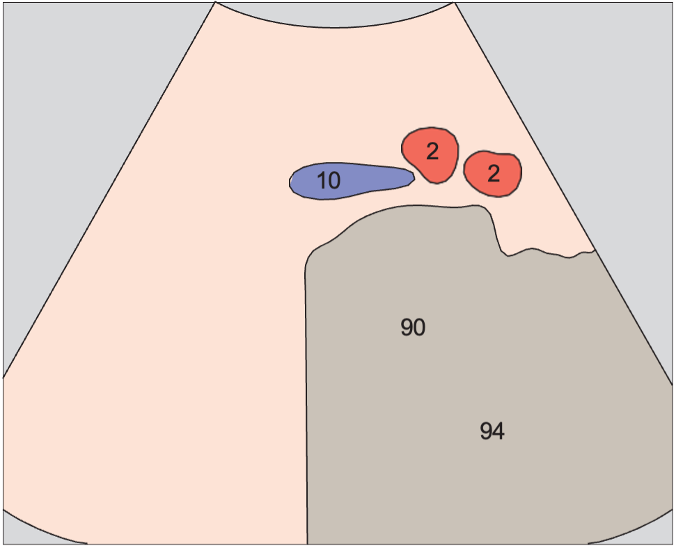 Artifact anatomy diagram, Aortic bifurcation