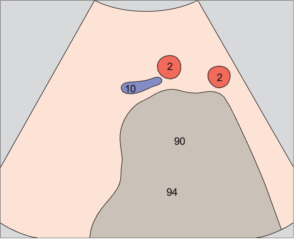 Artifact anatomy diagram, Iliac arteries