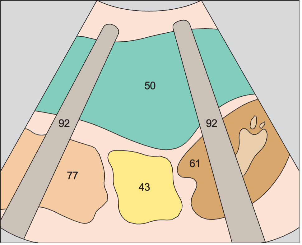 Spleen anatomy diagram, Kidney, spleen, bowel