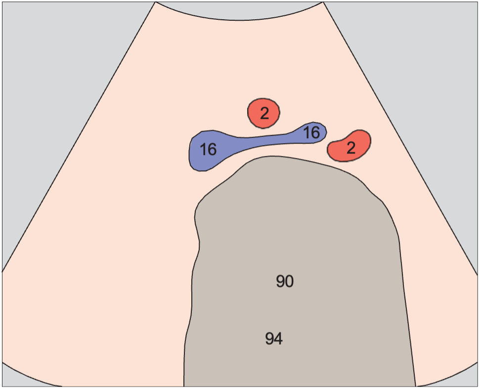 Artifact anatomy diagram, Confluence of iliac veins