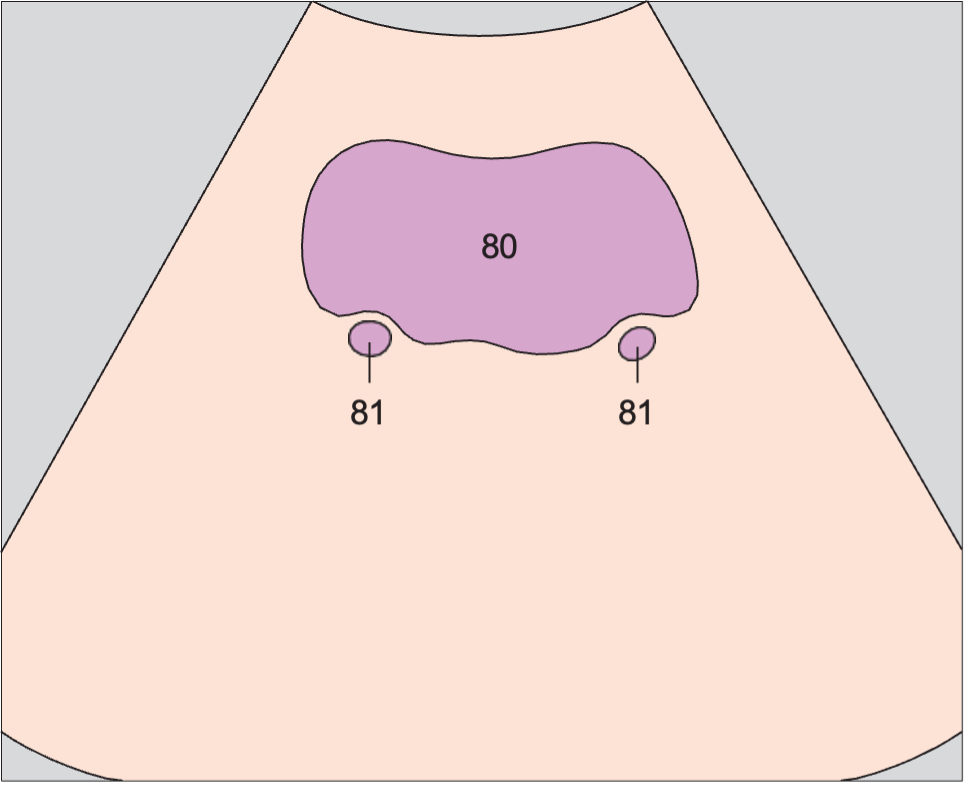 Bladder anatomy diagram, Bladder, ureteral orifices