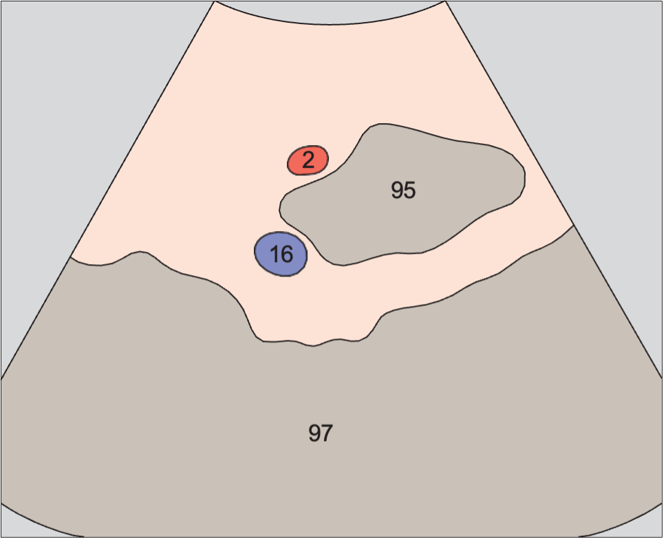 Pelvic bone anatomy diagram, Left iliac vessels