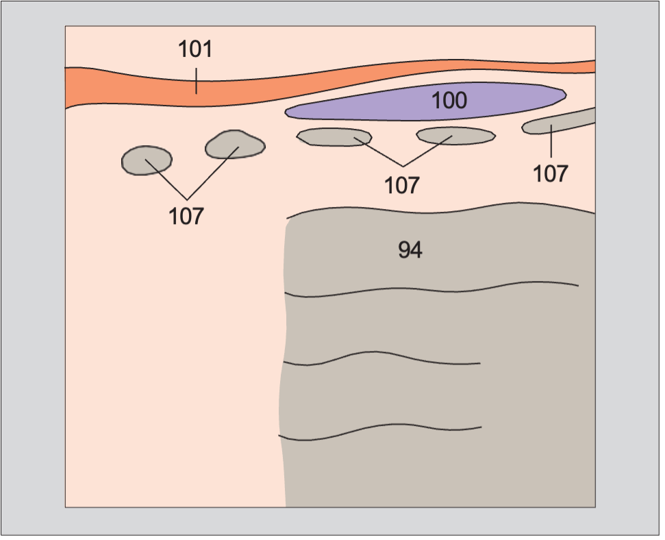 Sternohyoid muscle anatomy diagram, Isthmus of thyroid gland