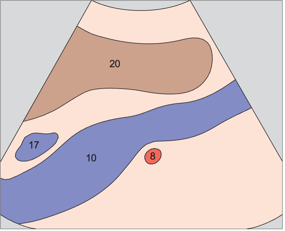 Right renal artery anatomy diagram, Vena cava and right renal artery