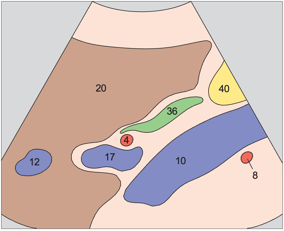 Middle hepatic vein anatomy diagram, Portal vein, vena cava, right renal artery, and bile duct