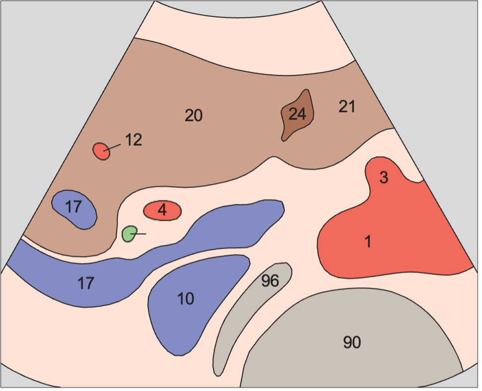 Middle hepatic vein anatomy diagram, Hepatic artery, portal vein, vena cava