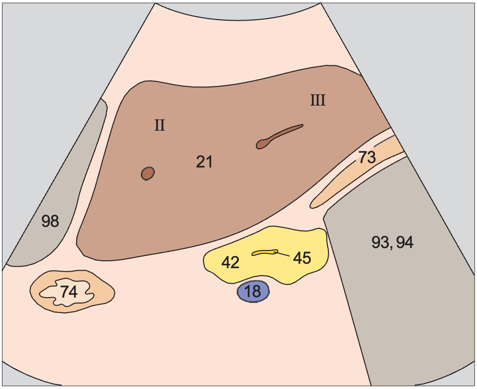 Gas anatomy diagram, Left lobe of liver, ligamentum teres, boundary between lateral and medial segments