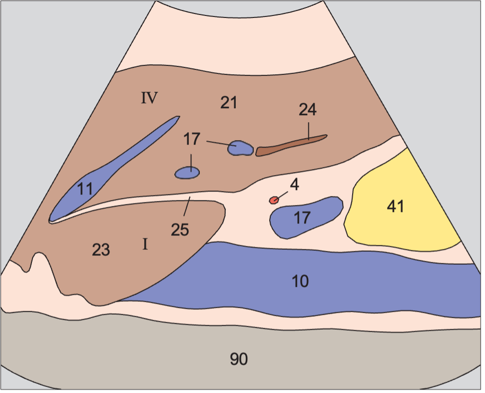 Caudate lobe anatomy diagram, Left hepatic vein, ligamentum teres, boundary between lateral and medial segments, caudate lobe