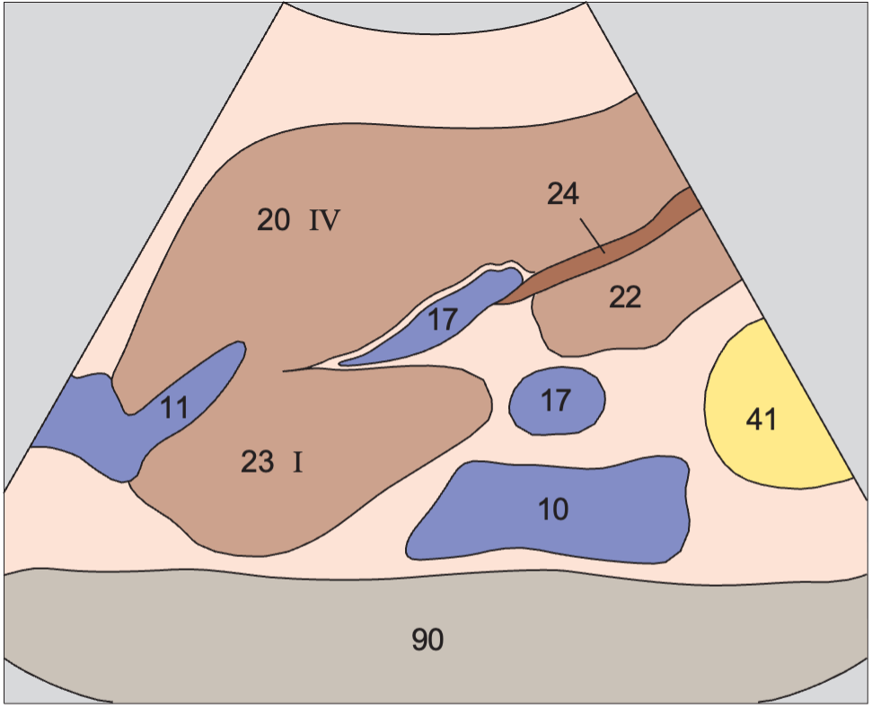 Caudate lobe anatomy diagram, Left hepatic vein, ligamentum teres, boundary between lateral and medial segments, caudate lobe