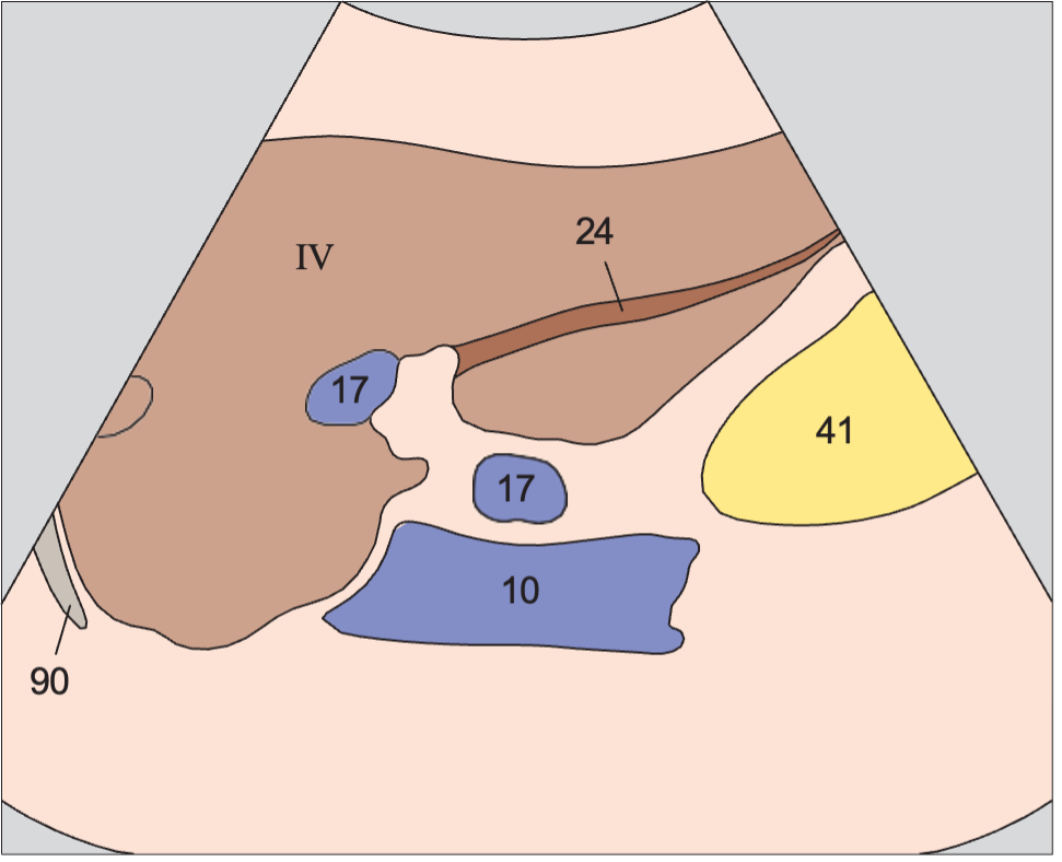 Gas anatomy diagram, Left hepatic vein, ligamentum teres, boundary between lateral and medial segments, caudate lobe