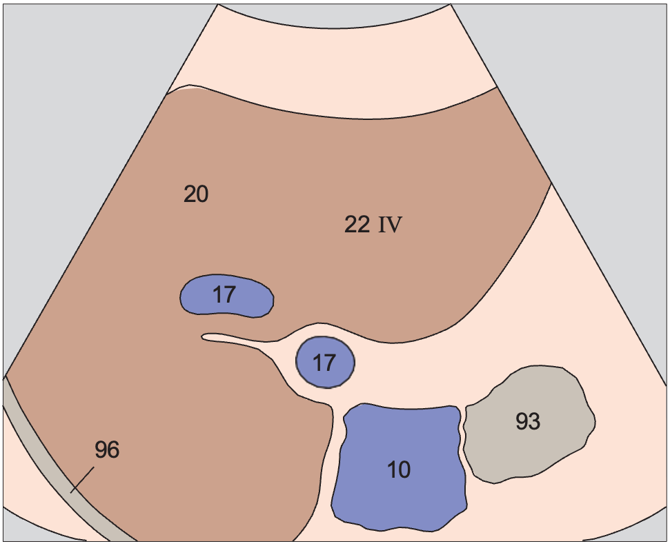 Gallbladder anatomy diagram, Medial segment, subsegment IV, quadrate lobe
