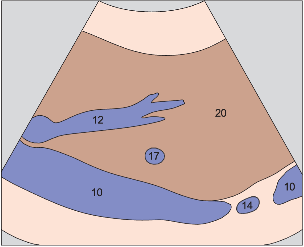 Middle hepatic vein anatomy diagram, Middle hepatic vein, boundary between medial and anterior segments