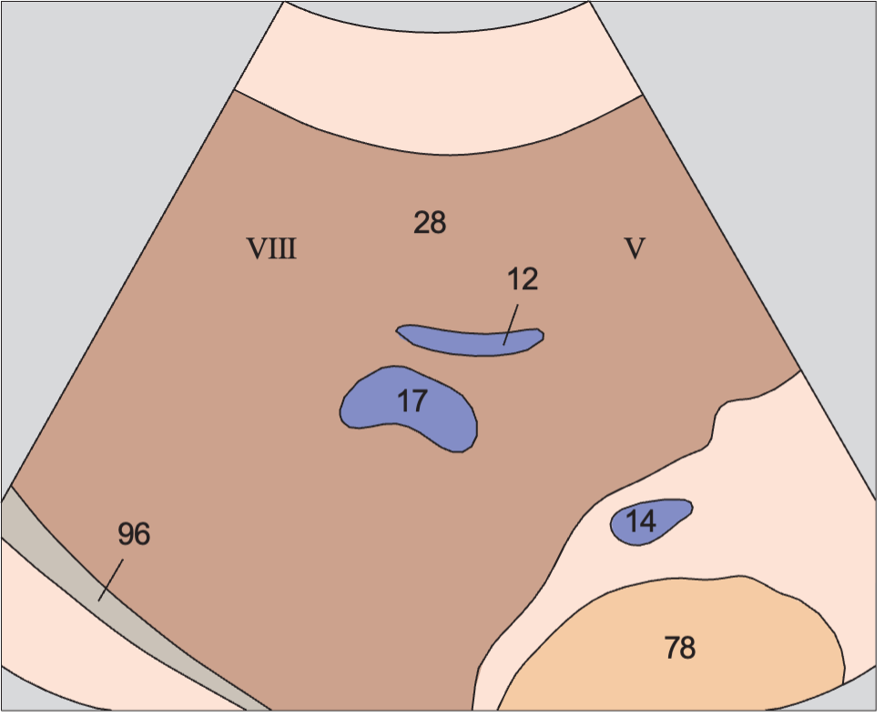 Middle hepatic vein anatomy diagram, Anterior segment, subsegments VIII and V
