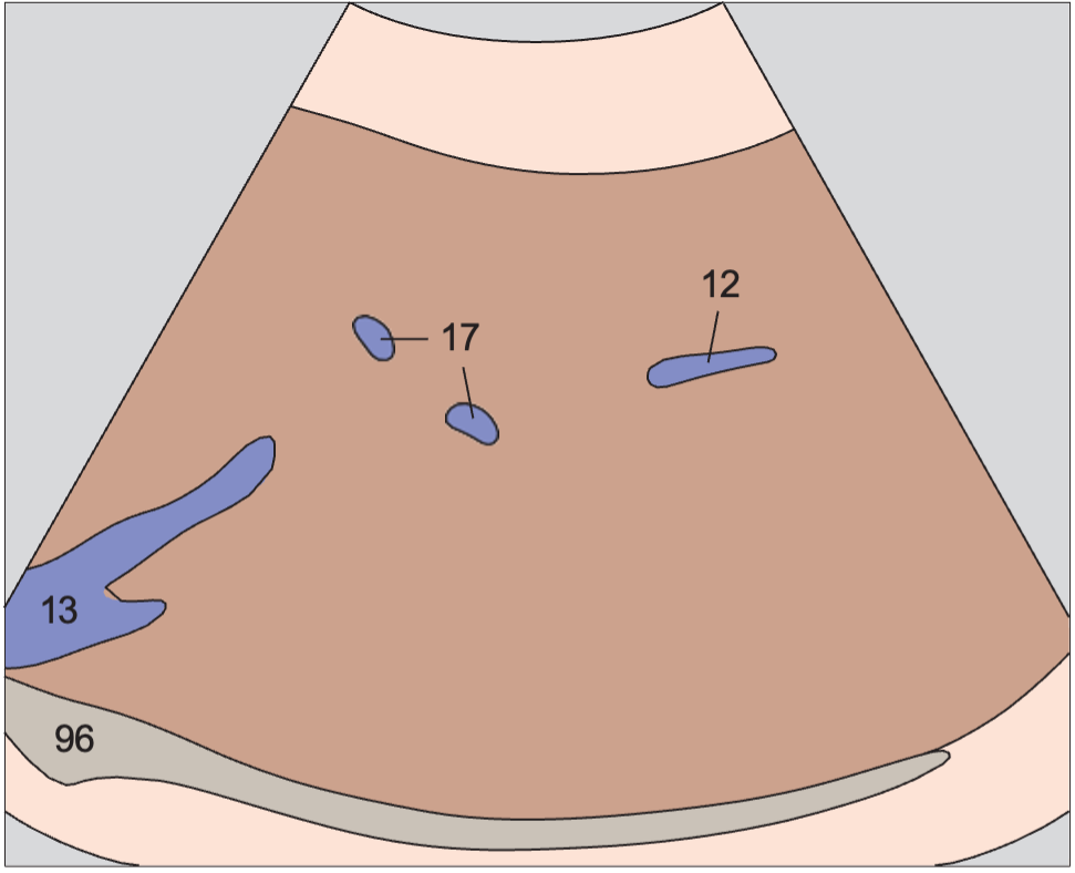 Posterior segment anatomy diagram, Right hepatic vein, boundary between anterior and posterior segments