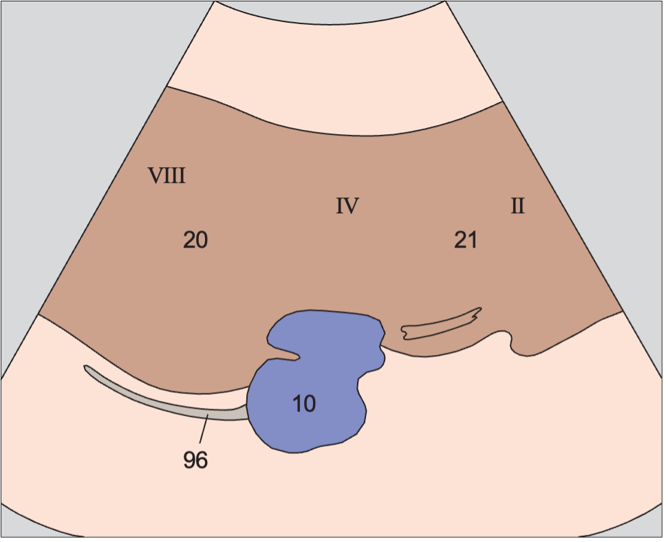 Left lobe of liver anatomy diagram, Medial and anterior hepatic segments, opening of hepatic veins