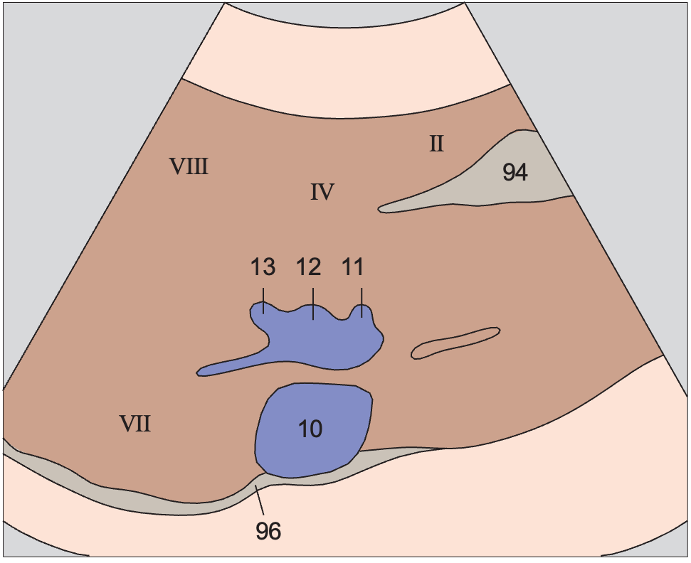 Middle hepatic vein anatomy diagram, Medial and anterior hepatic segments, opening of hepatic veins