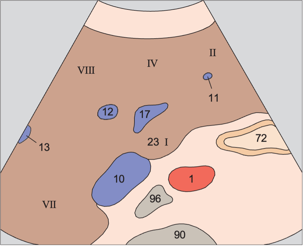 Caudate lobe anatomy diagram, Medial and anterior hepatic segments, left portal vein branch, caudate lobe