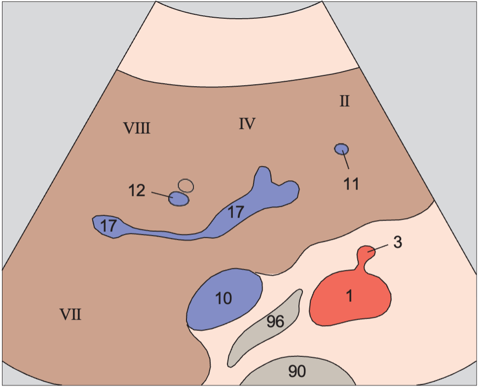 Middle hepatic vein anatomy diagram, Medial and anterior hepatic segments, left portal vein branch, caudate lobe