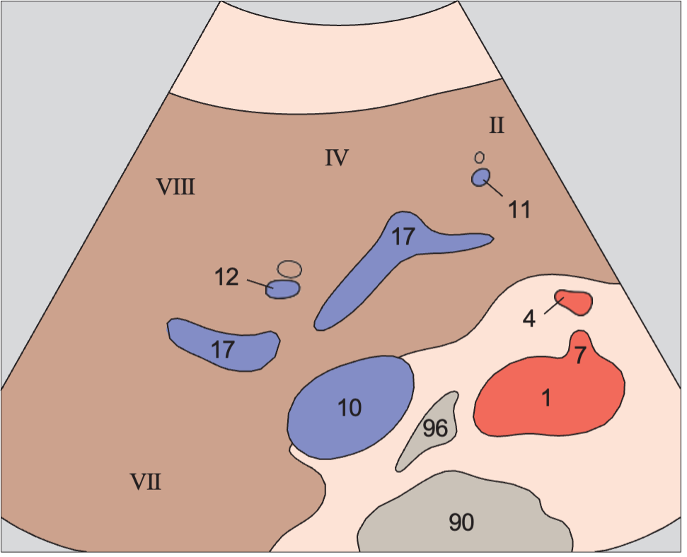 Middle hepatic vein anatomy diagram, Medial and anterior hepatic segments, bifurcation of portal vein