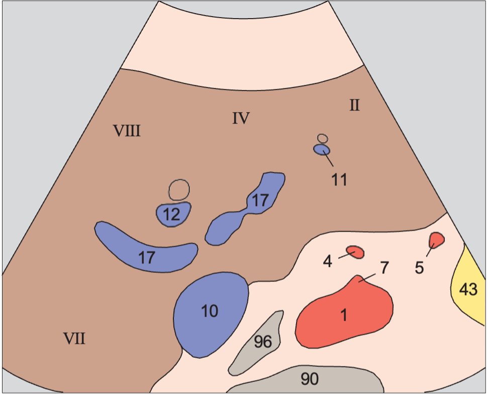 Middle hepatic vein anatomy diagram, Medial and anterior hepatic segments, bifurcation of portal vein