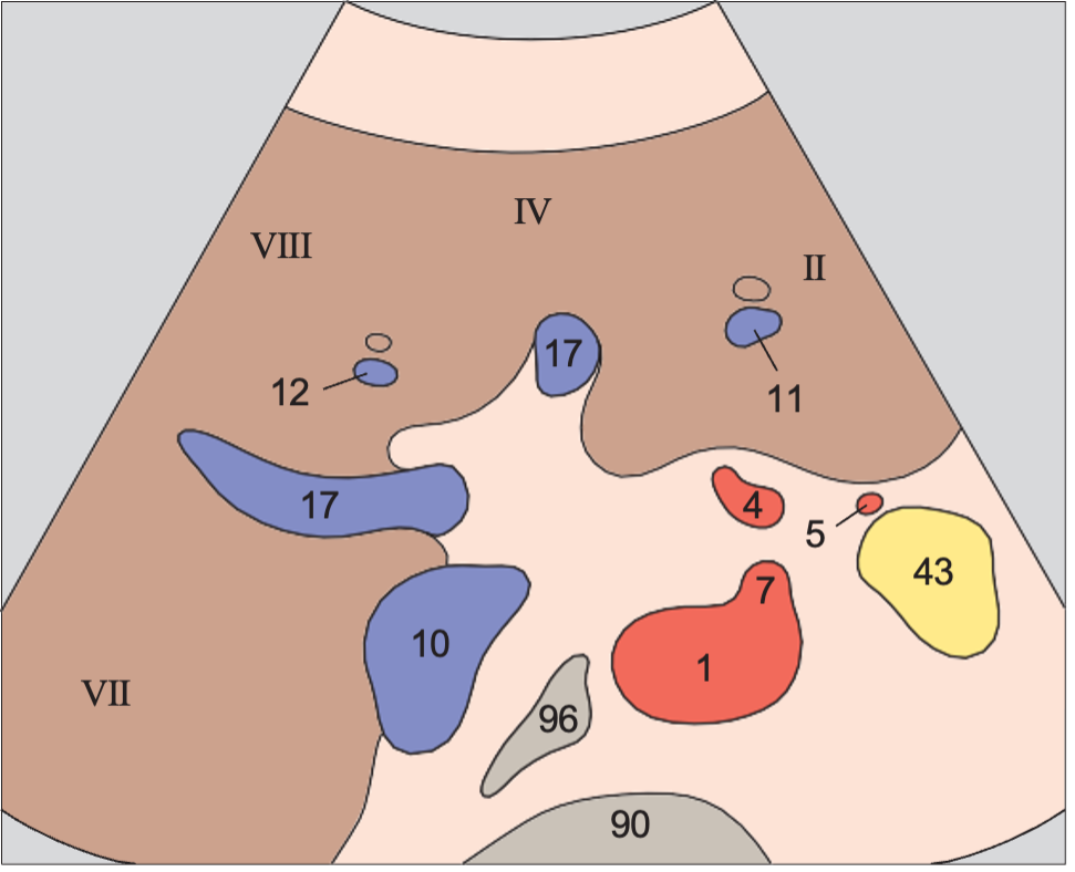Middle hepatic vein anatomy diagram, Medial and anterior hepatic segments, right portal vein branch