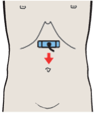 Probe position, Left renal vein and right renal artery