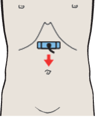 Probe position, Infrarenal aorta and vena cava