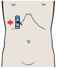 Probe position, Gallbladder fundus, kidney