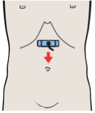 Probe position, Infrarenal aorta and vena cava