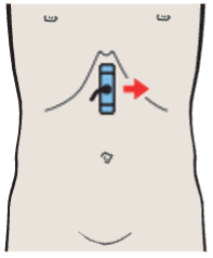 Probe position, Head of pancreas, superior mesenteric vein, uncinate process