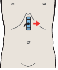 Probe position, Body of pancreas, splenic vein