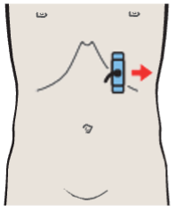 Probe position, Tail of pancreas
