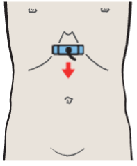 Probe position, Body of pancreas, splenic vein