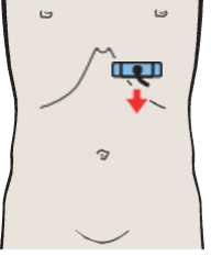 Probe position, Tail of pancreas, splenic artery