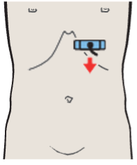 Probe position, Tail of pancreas, splenic vein