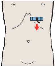 Probe position, Tail of pancreas