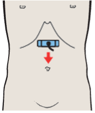 Probe position, Infrarenal aorta, vena cava, superior mesenteric artery and vein