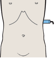 Probe position, Spleen, tail of pancreas, kidney