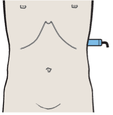 Probe position, Spleen, tail of pancreas, kidney