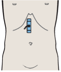 Probe position, Longitudinal scan of pancreatic duct