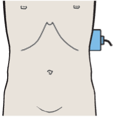 Probe position, Accessory spleen