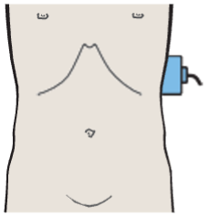 Probe position, Accessory spleen