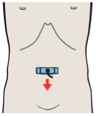 Probe position, Aortic bifurcation