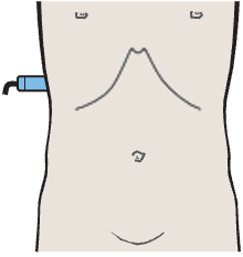 Probe position, Kidney, liver, psoas muscle, quadratus lumborum muscle